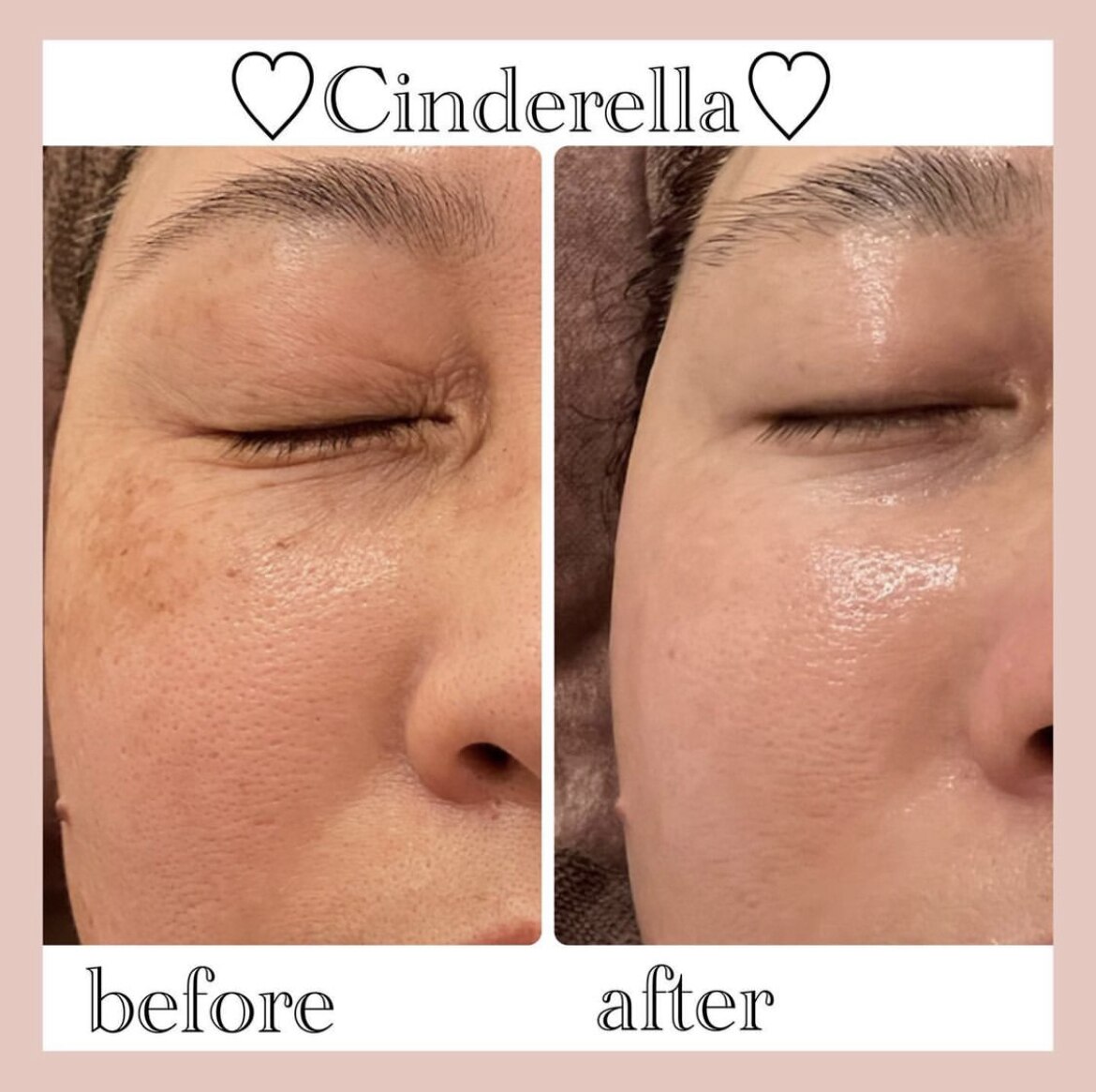 シミケアプログラムの症例 1