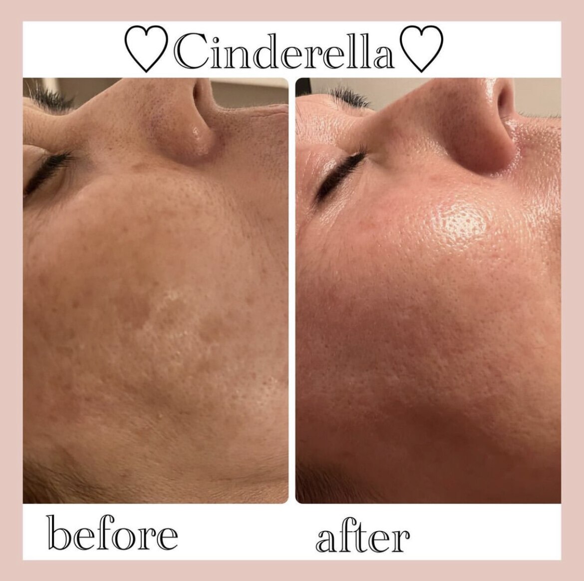 シミケアプログラムの症例 2