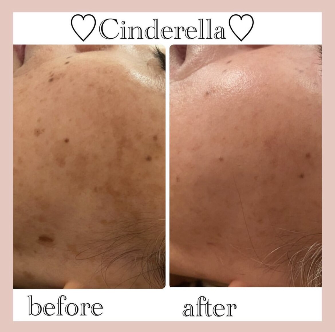 シミケアプログラムの症例 3