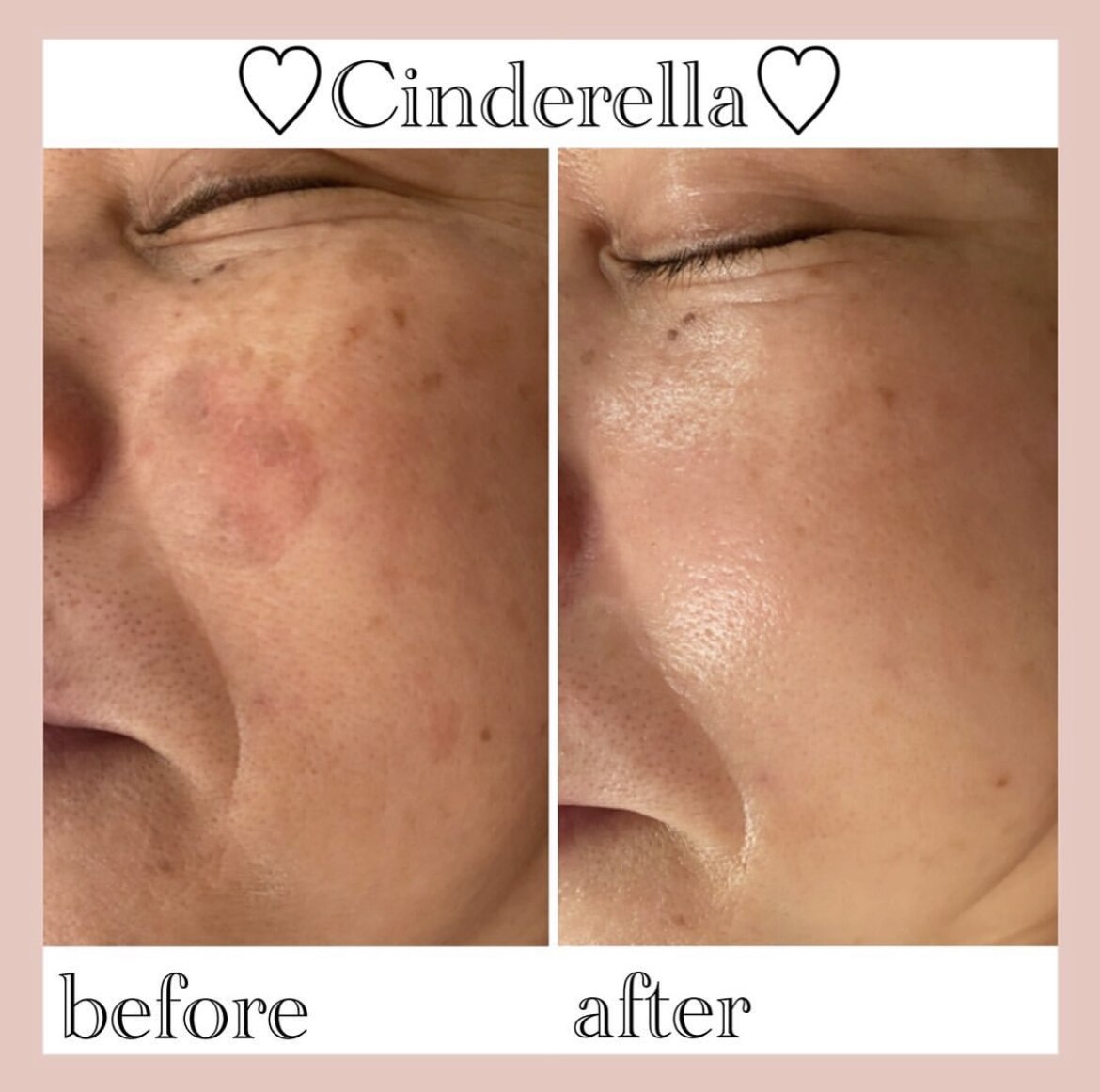 シミケアプログラムの症例 4