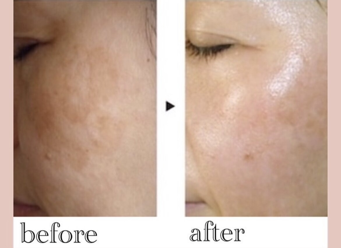 シミケアプログラムの症例 5