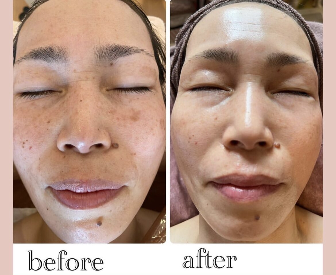 シミケアプログラムの症例 6