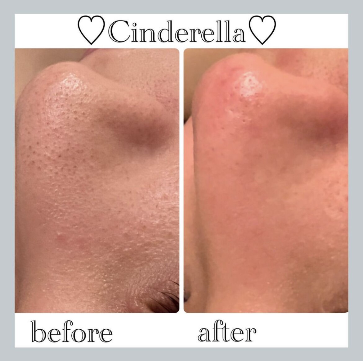 毛穴洗浄＋毛穴縮小マシーンの症例