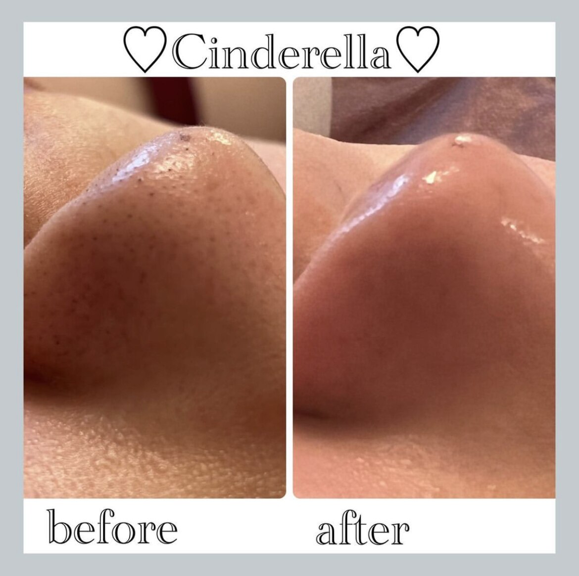 毛穴洗浄＋毛穴縮小マシーンの症例 2