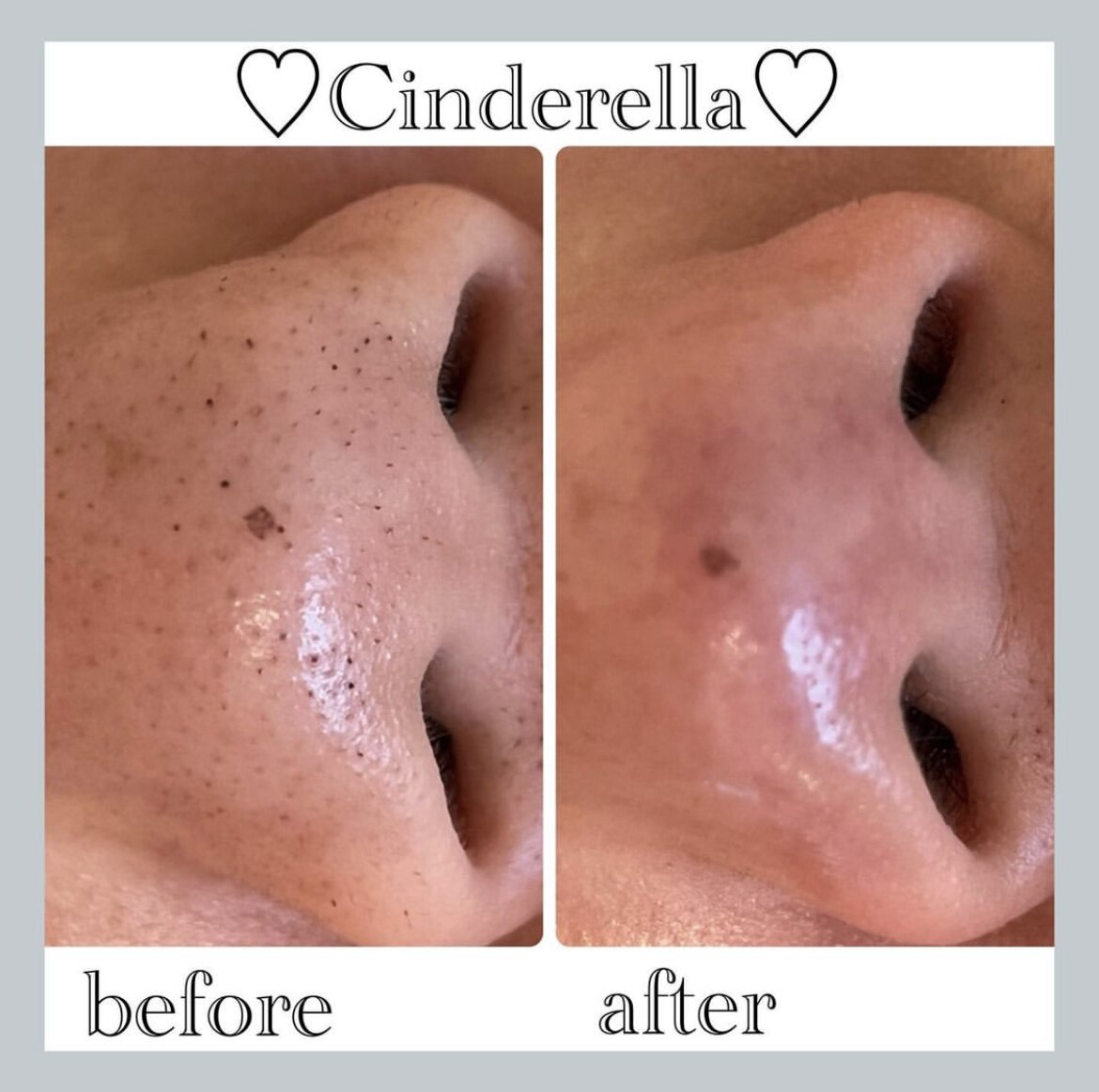 毛穴洗浄＋Wax＋毛穴縮小マシーンの症例