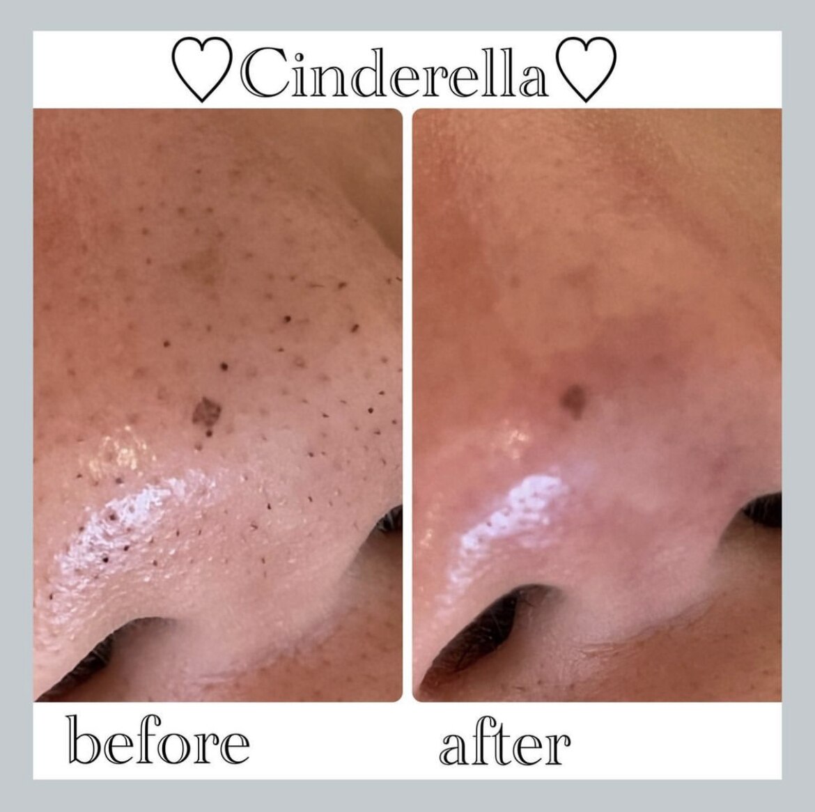 毛穴洗浄＋Wax＋毛穴縮小マシーンの症例