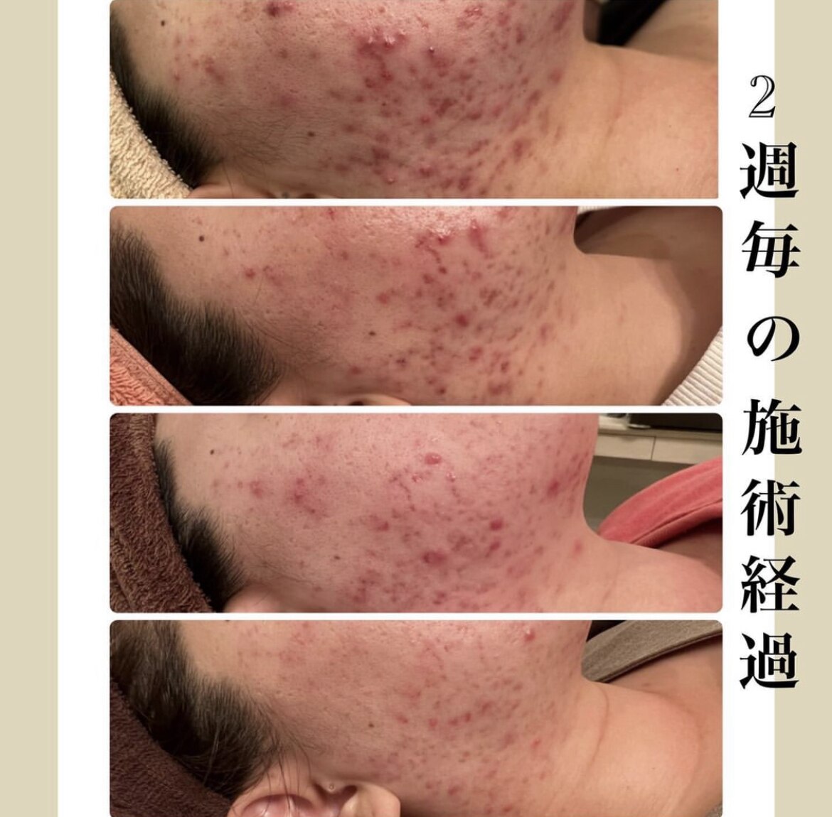 ニキビケアの症例