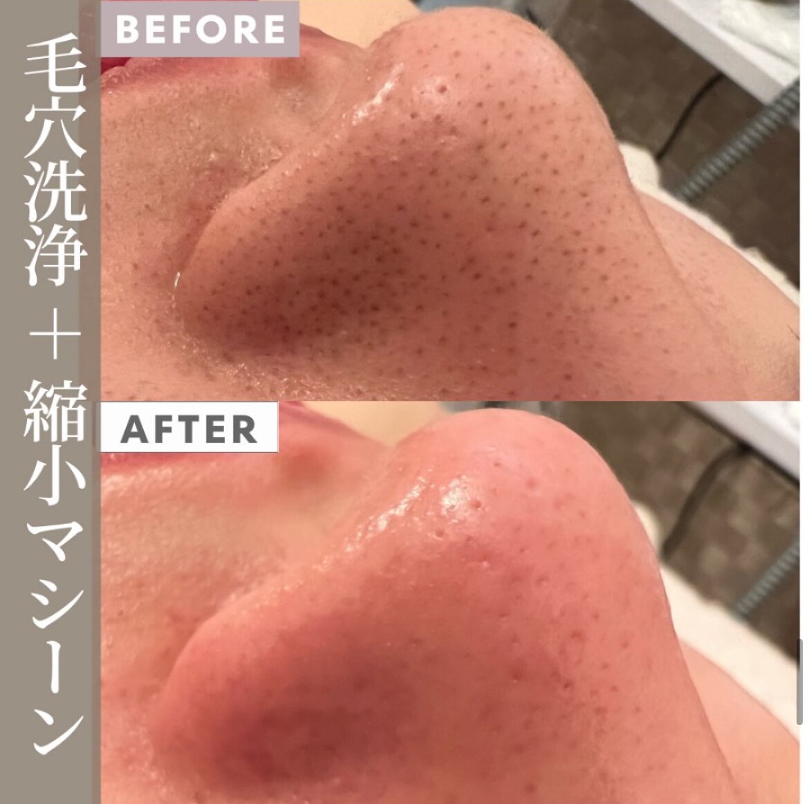 毛穴洗浄＋毛穴縮小マシーンの症例