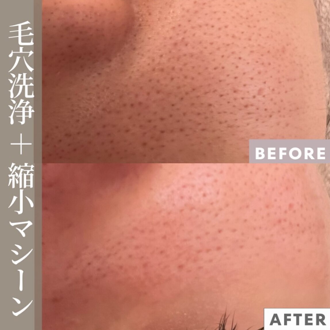 毛穴洗浄＋毛穴縮小マシーンの症例
