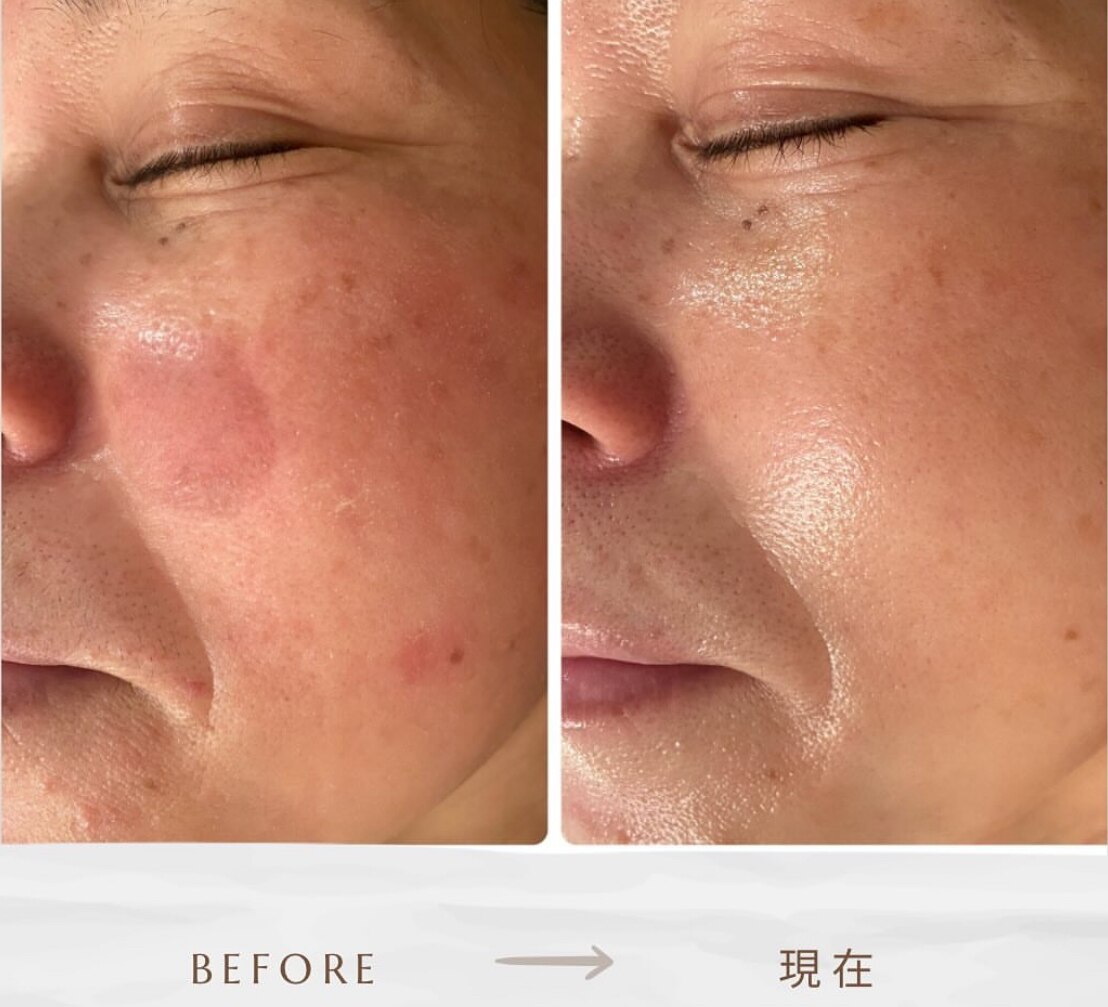 シミケアプログラムの症例