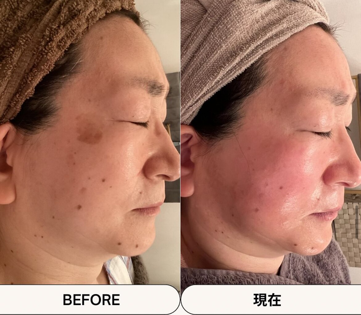 シミケアプログラムの症例