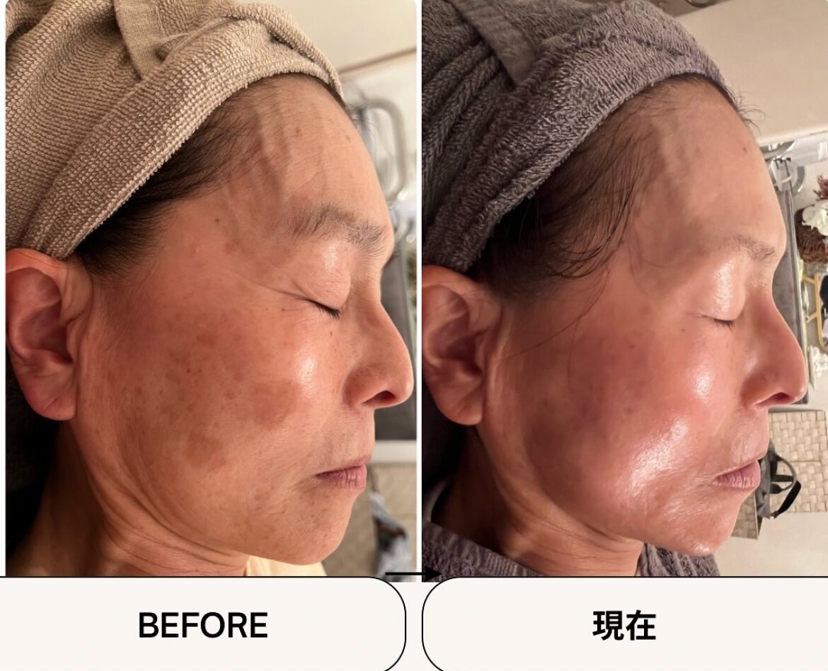 シミケアプログラムの症例