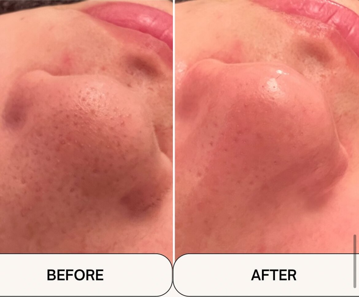 毛穴洗浄＋Wax＋毛穴縮小マシーンの症例