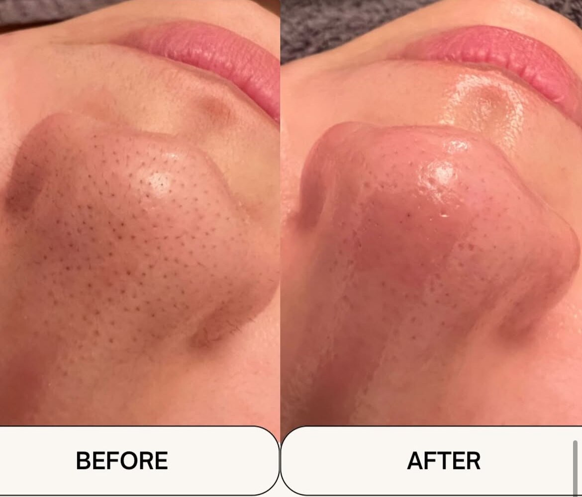 毛穴洗浄＋Wax＋毛穴縮小マシーンの症例