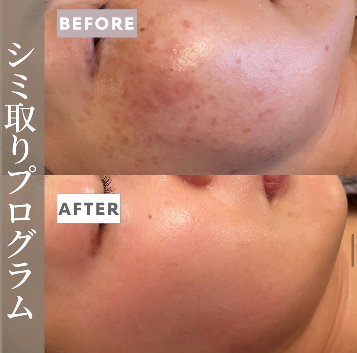 シミケアプログラムの症例