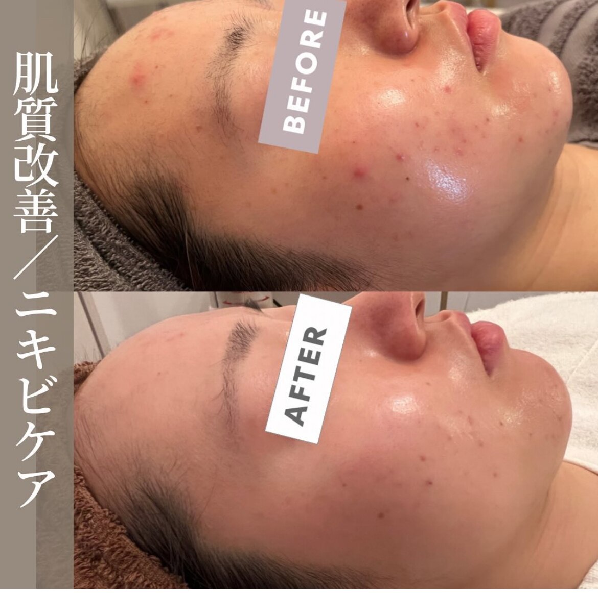 ニキビケアの症例