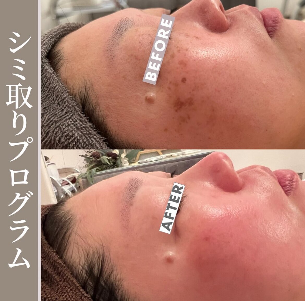 シミケアプログラムの症例