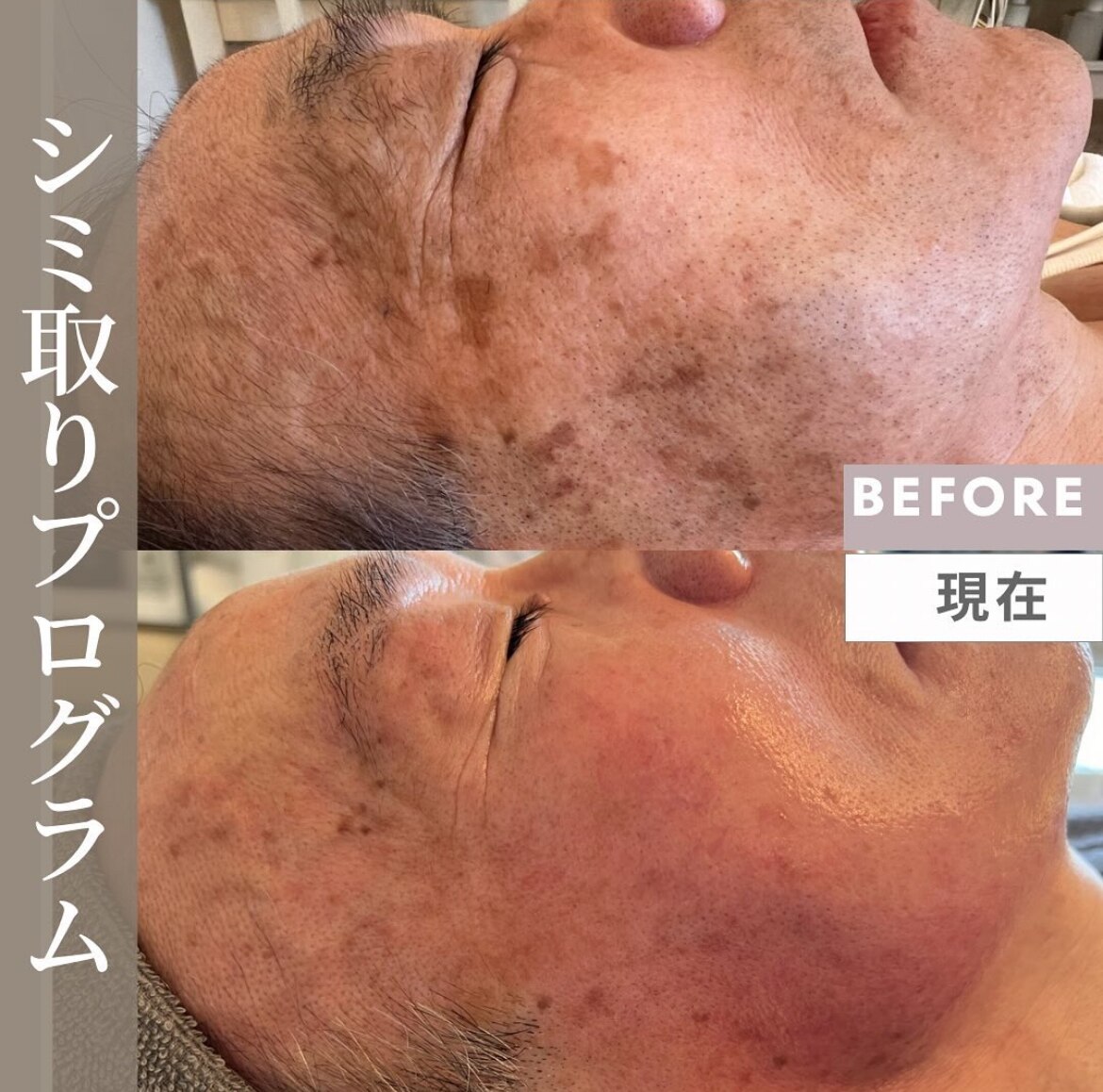 シミケアプログラムの症例