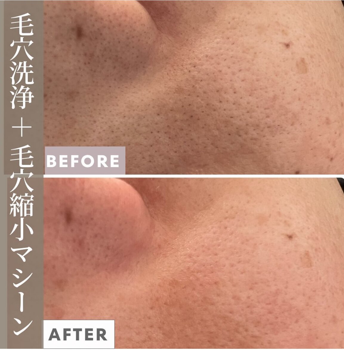 毛穴洗浄＋毛穴縮小マシーンの症例