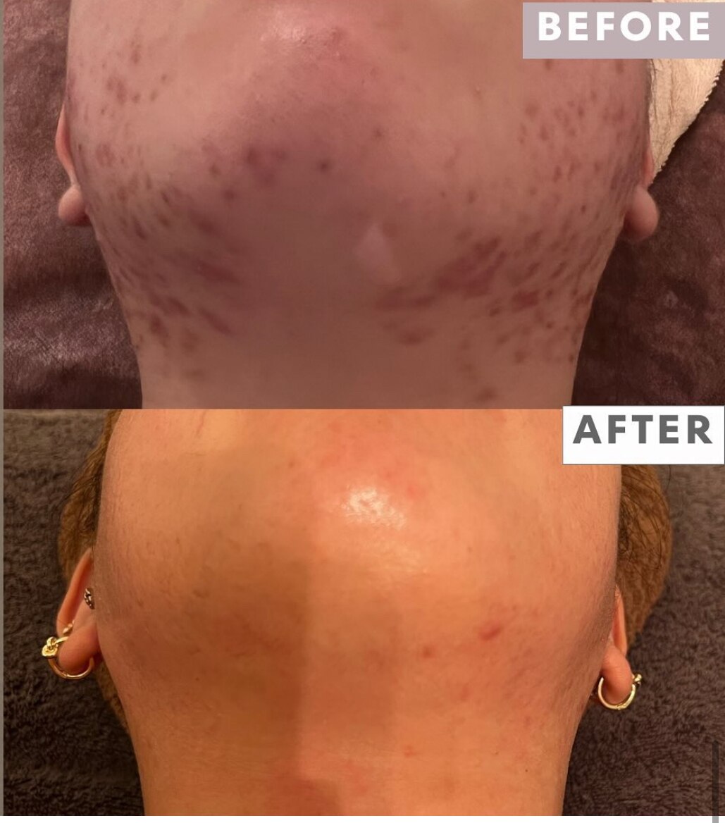 ニキビケアの症例