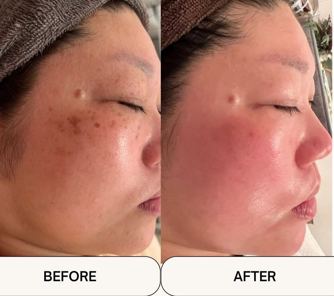 シミケアプログラムの症例