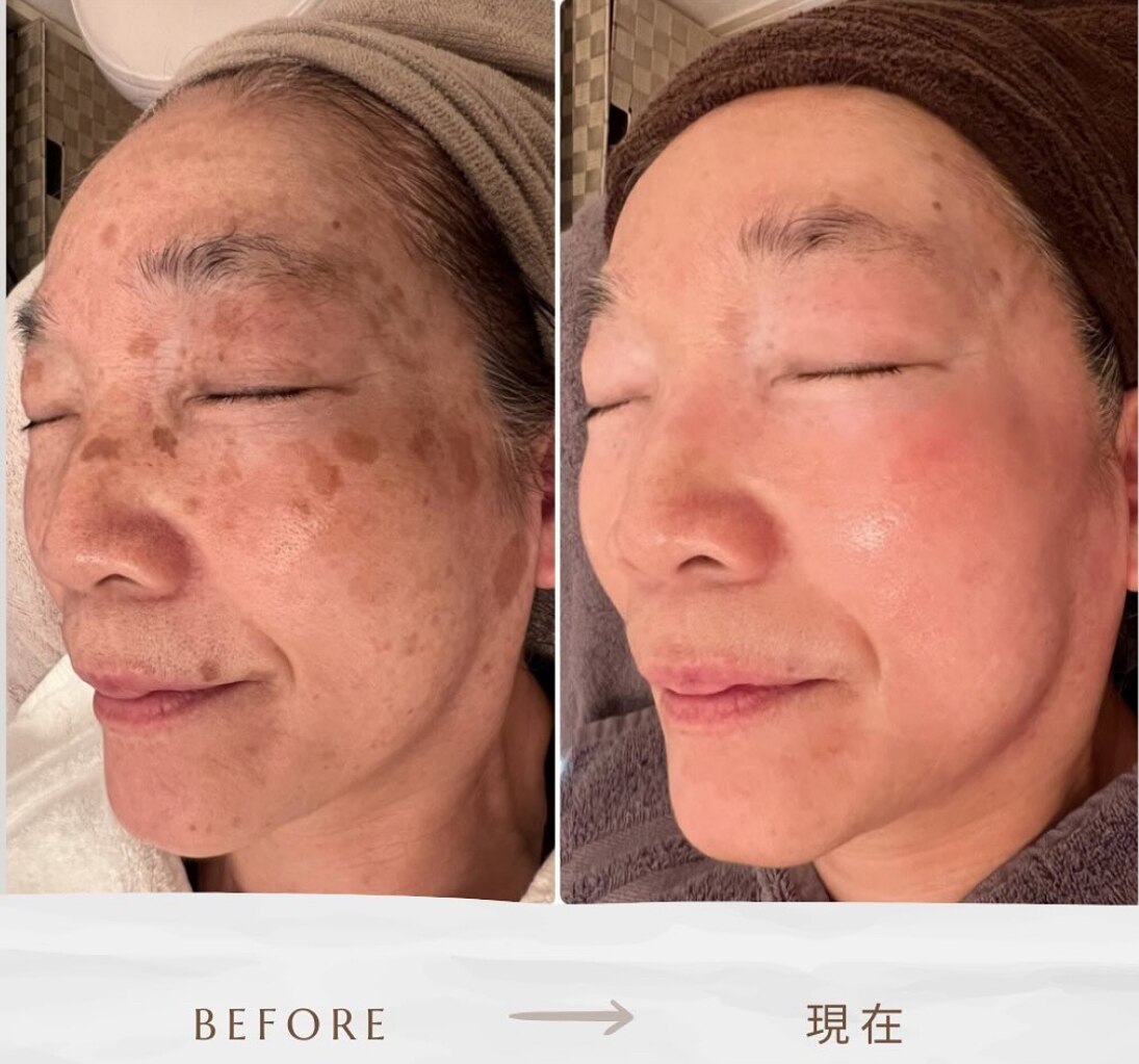 シミケアプログラムの症例