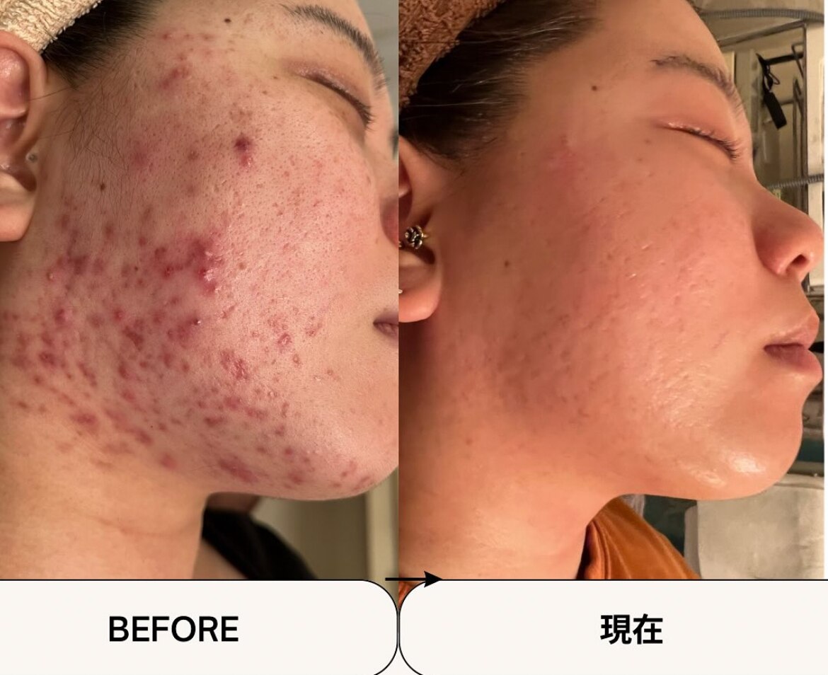 ニキビケアの症例