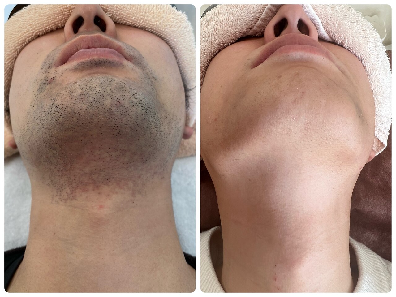 髭脱毛の症例 1