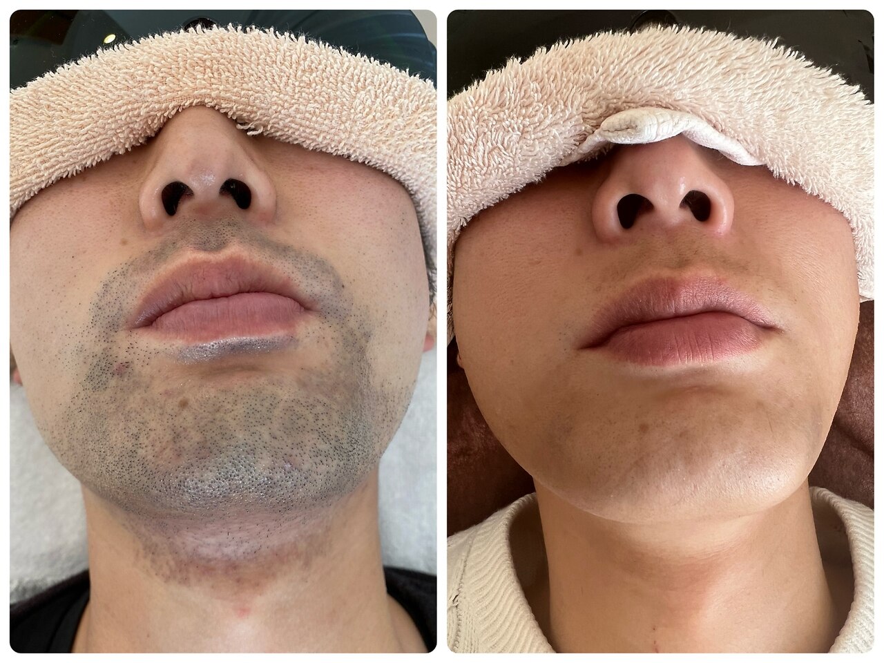 髭脱毛の症例 2