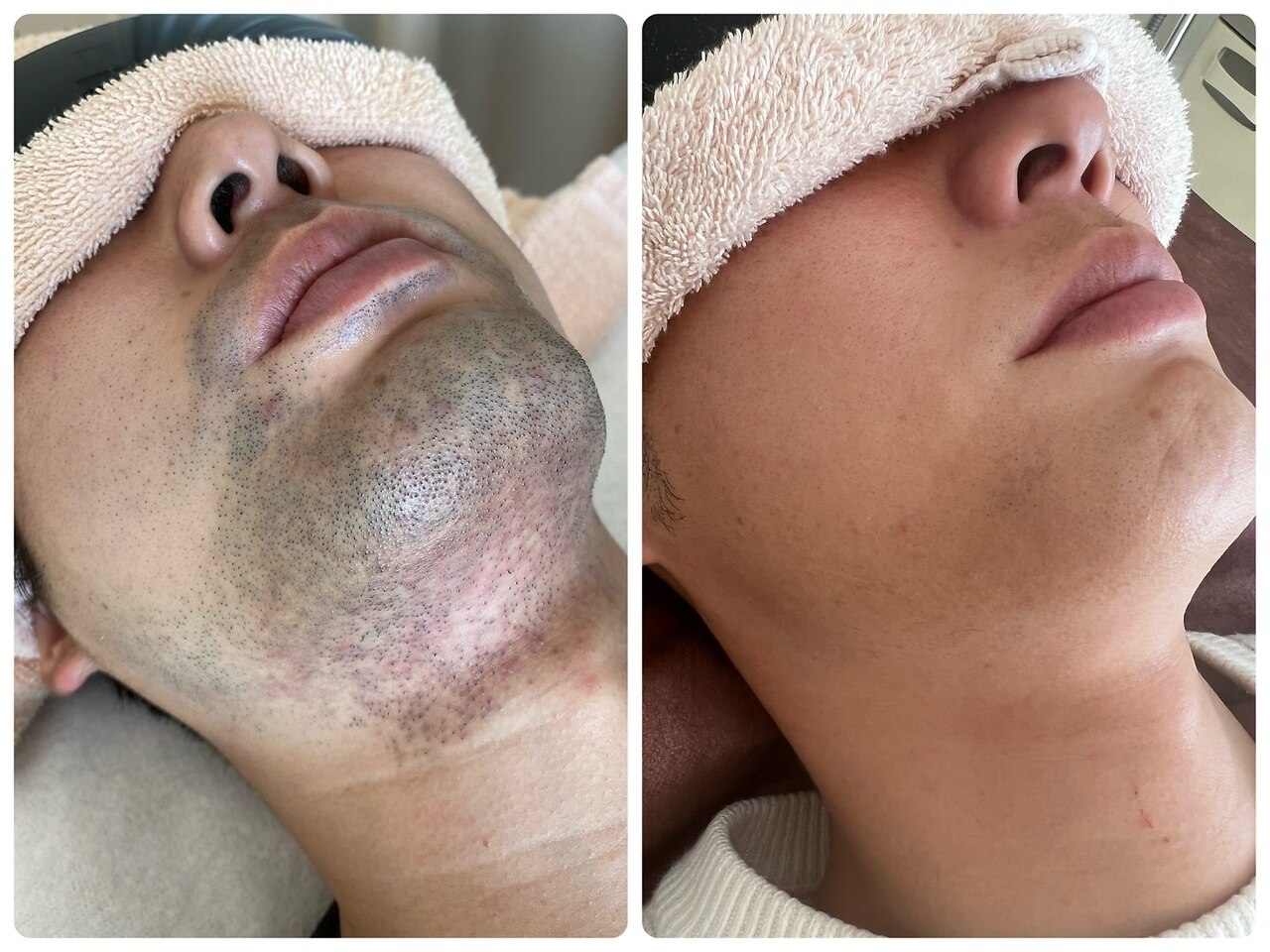 髭脱毛の症例 3