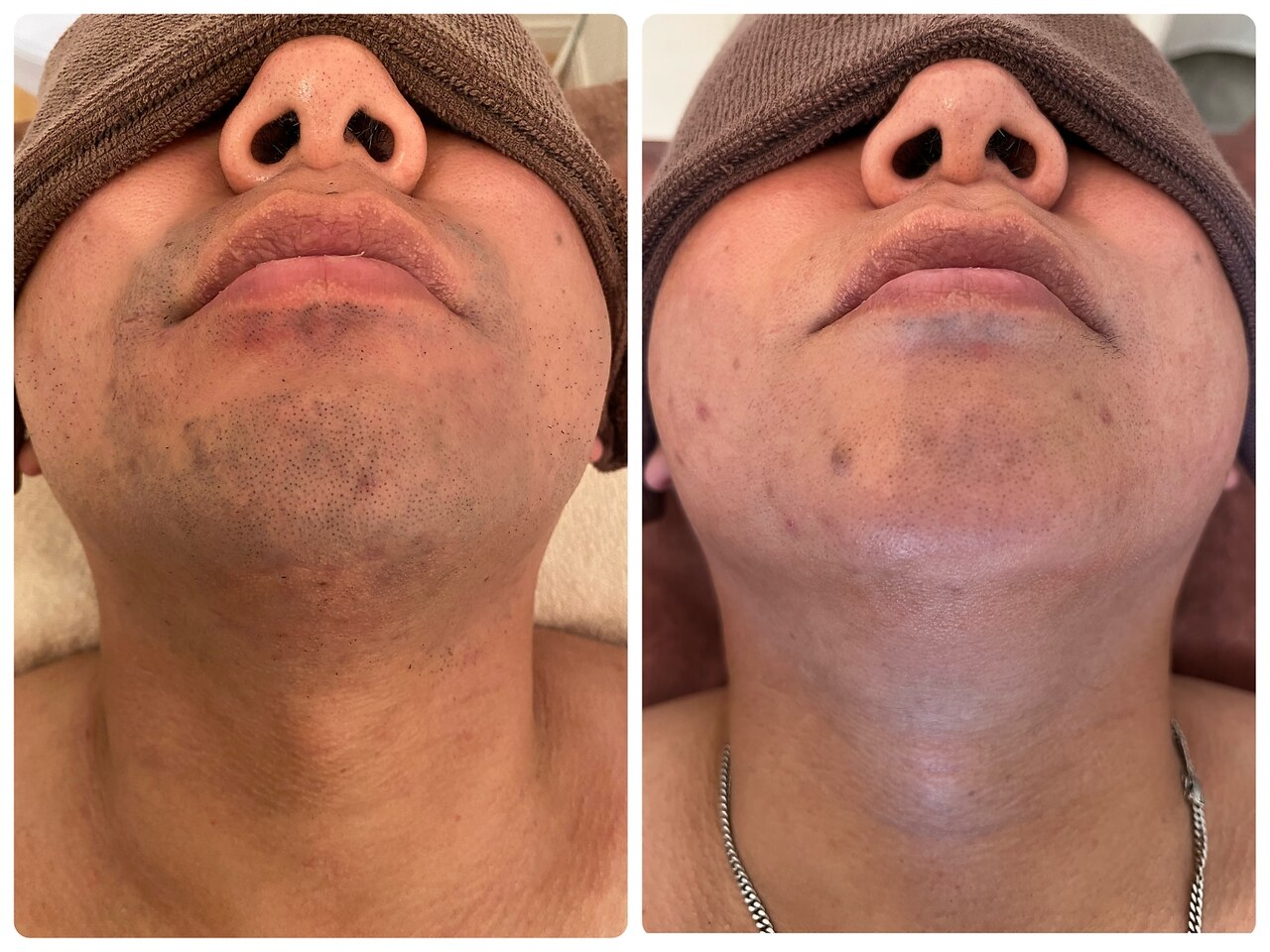 髭脱毛の症例 4