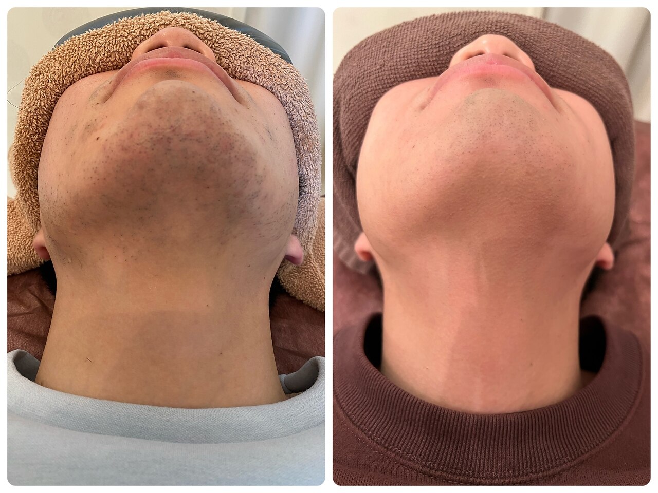 髭脱毛の症例 5