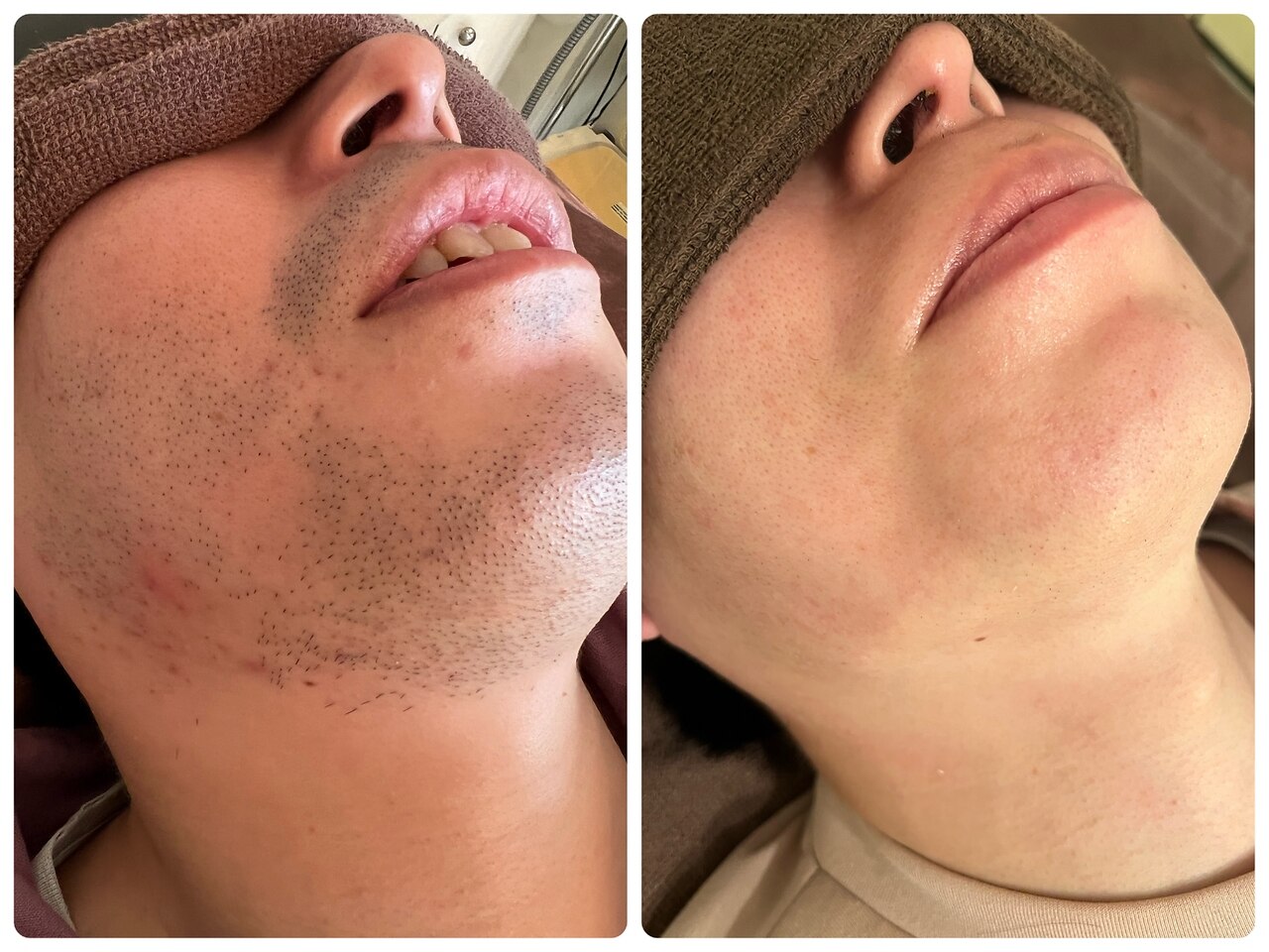 髭脱毛の症例 6