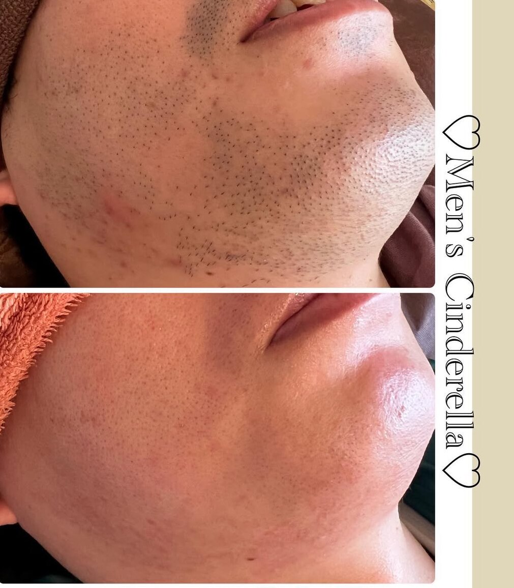 髭脱毛の症例 7