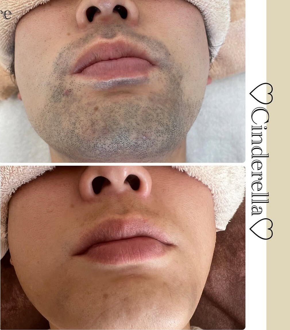 髭脱毛の症例 8