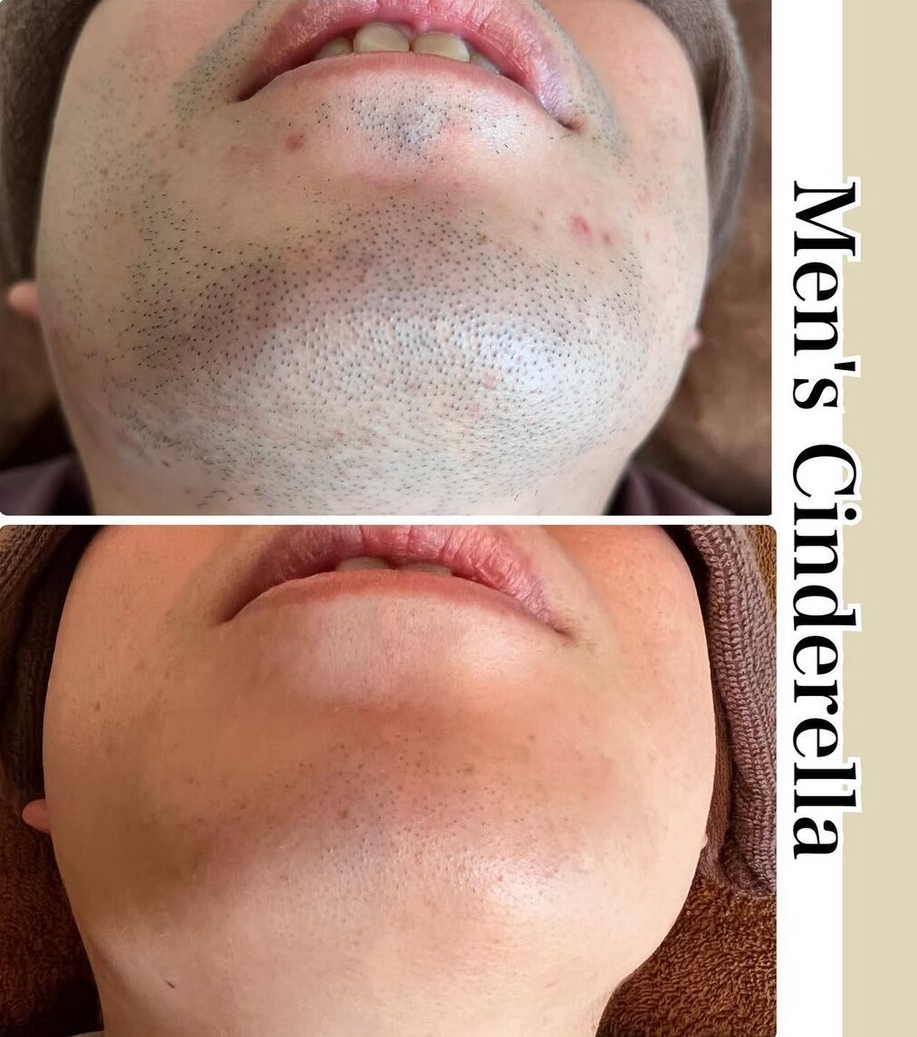 髭脱毛の症例 9