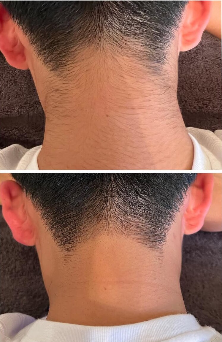 うなじ脱毛の症例