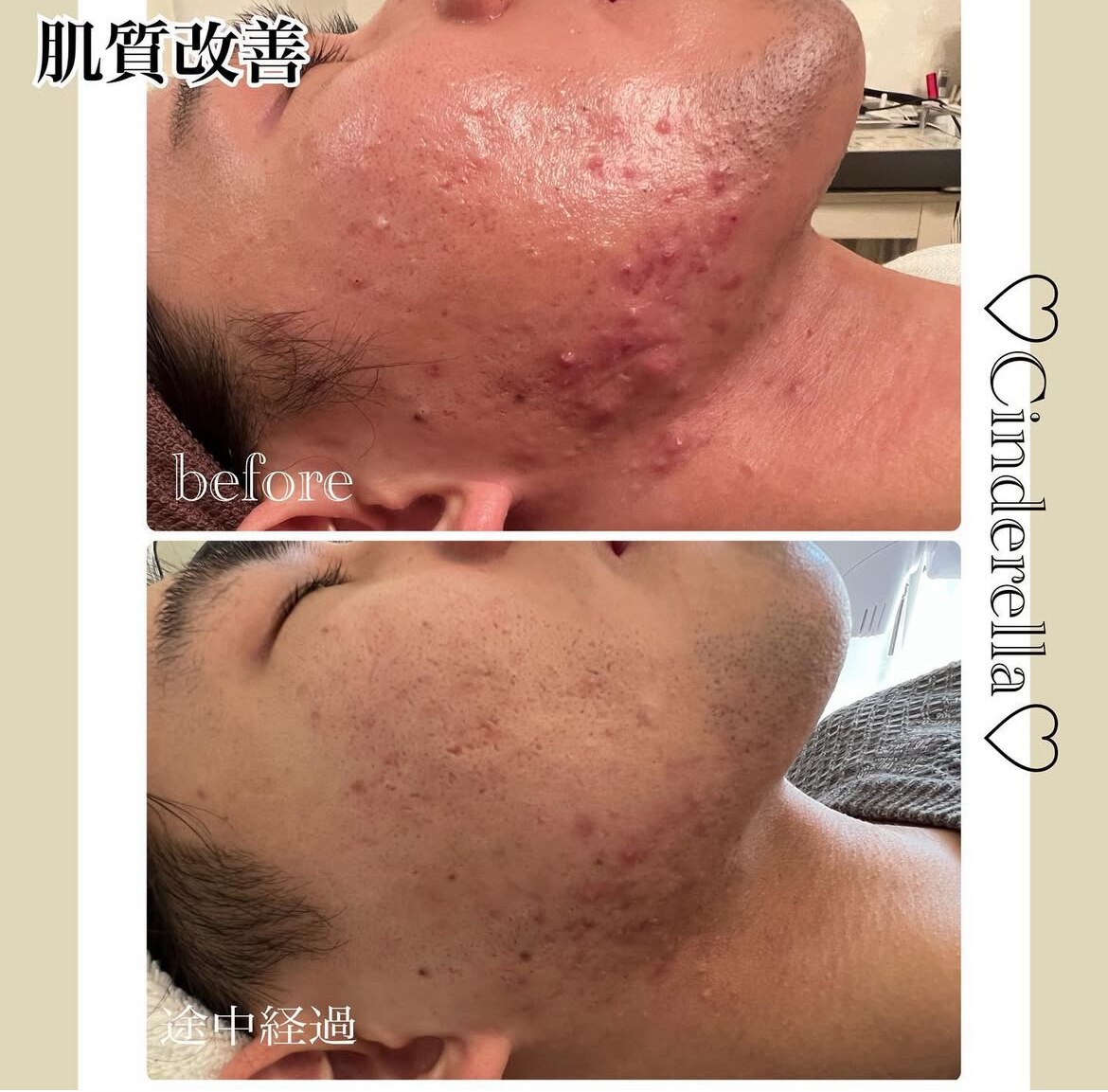 ニキビケアの症例