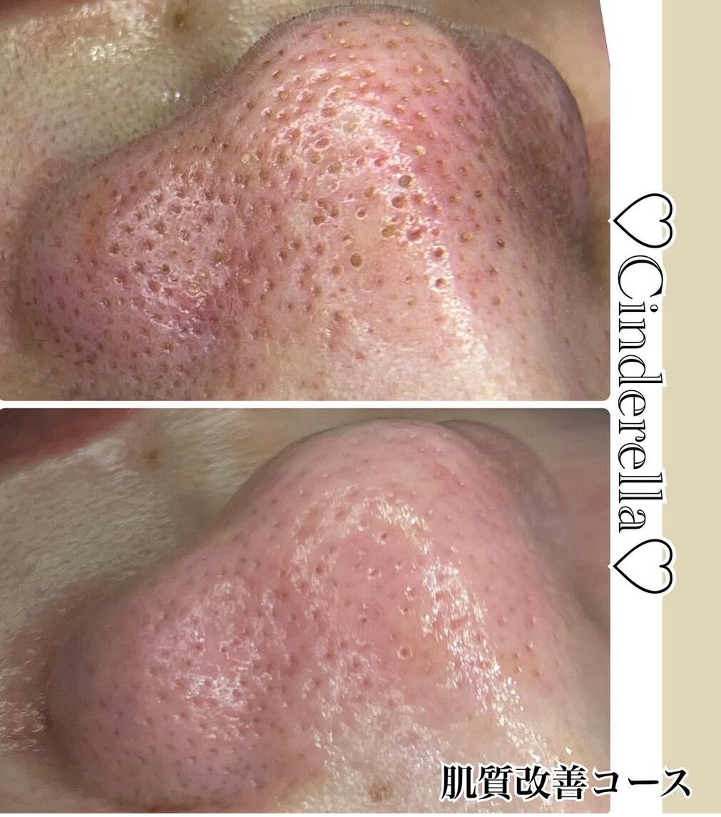 フェイシャル/毛穴洗浄の症例