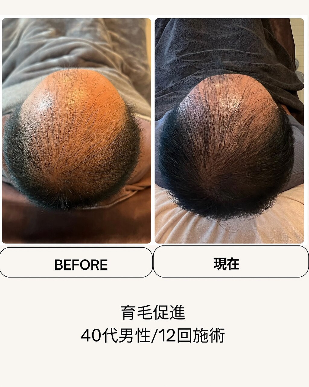 育毛促進コースの症例