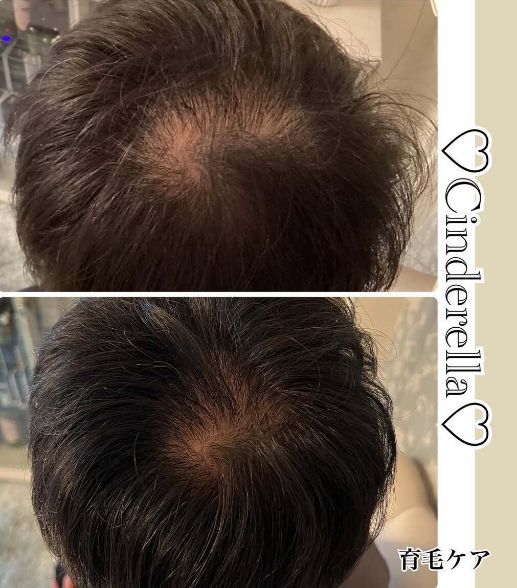 育毛促進コースの症例