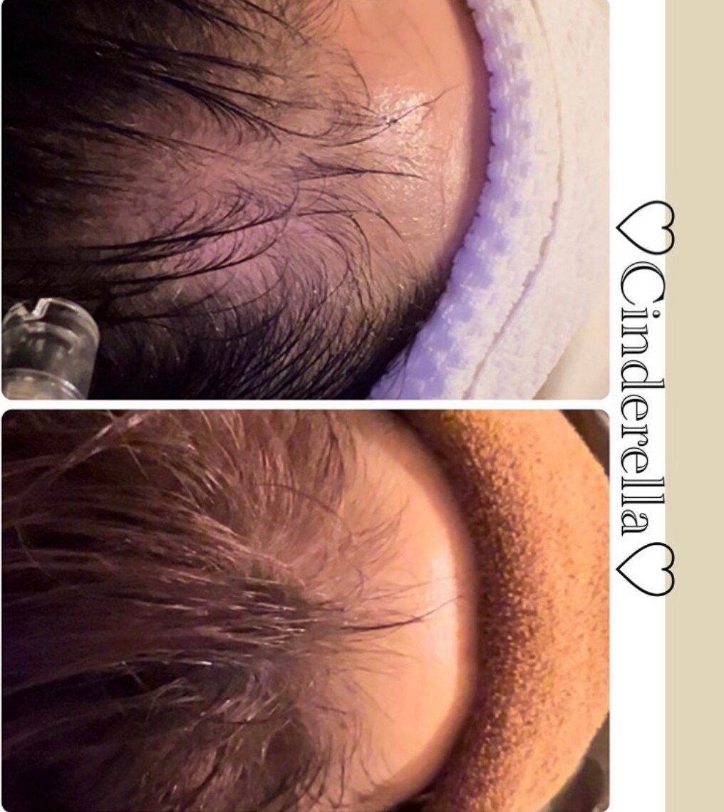 育毛促進コースの症例