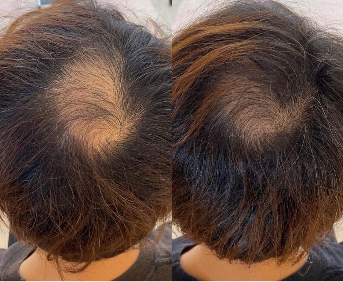 育毛促進コースの症例