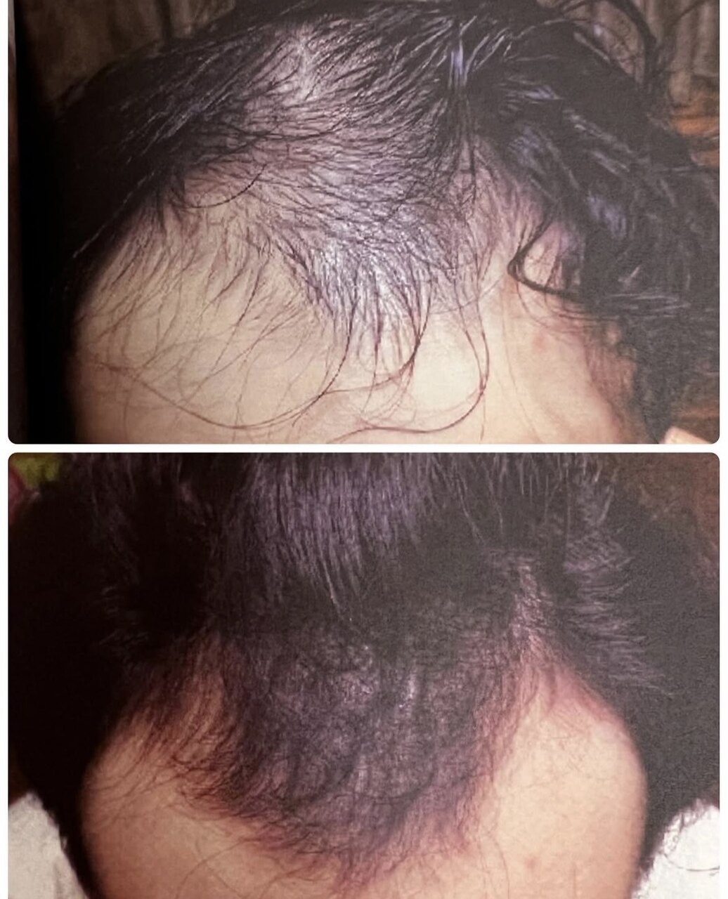 育毛促進コースの症例