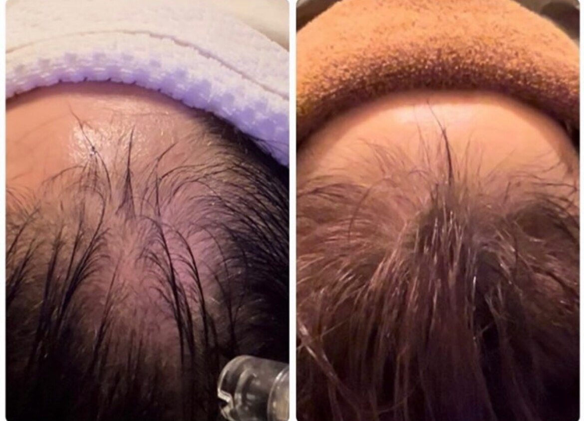 育毛促進コースの症例