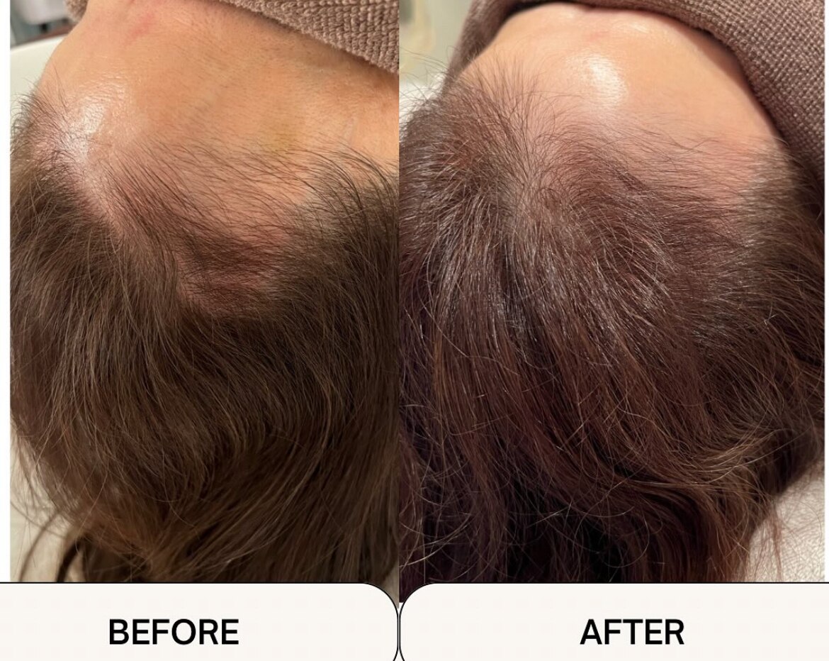 育毛促進コースの症例