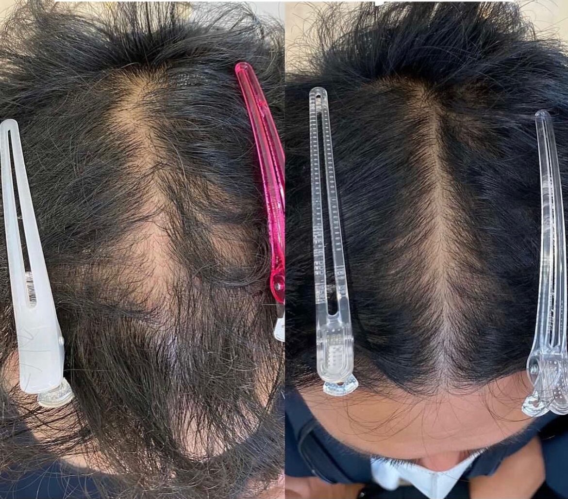 育毛促進コースの症例