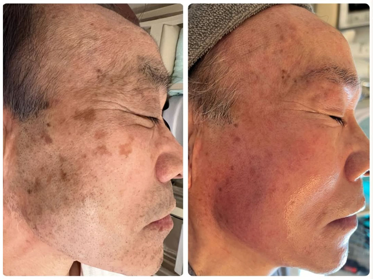 メンズ症例写真3